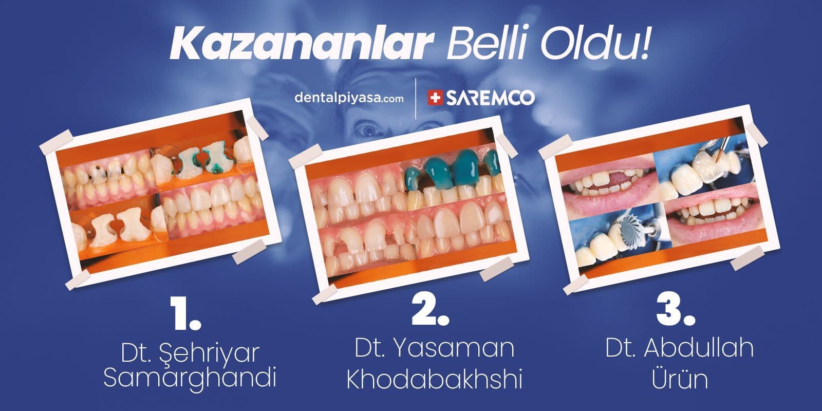 DentalUzman Restoratif Vaka Yarışması – Kazananlar Belli Oldu !
