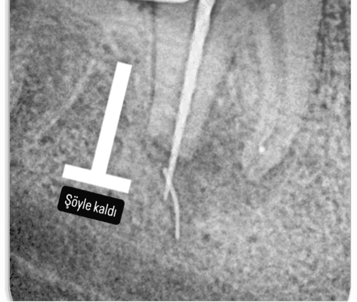  Kök Ucundan Taşmış Kırık Eğeye Sahip Alt Çene Büyükazı Dişinin Endodontik Yönetimi -  Uzm. Dt. Yahya Güven