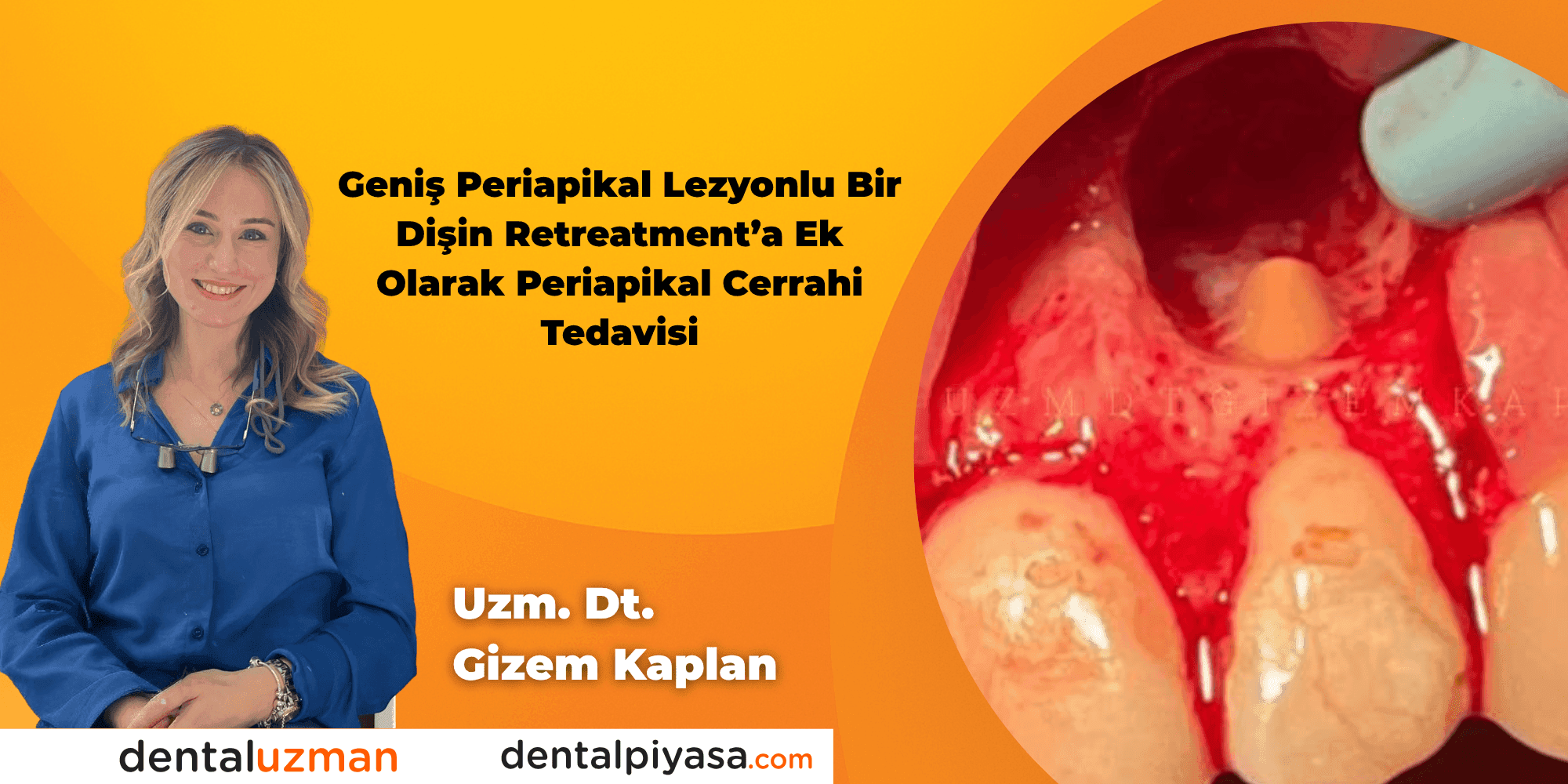 Geniş Periapikal Lezyonlu Bir Dişin Retreatment’a Ek Olarak Periapikal Cerrahi Tedavisi - Uzm. Dt. Gizem Kaplan