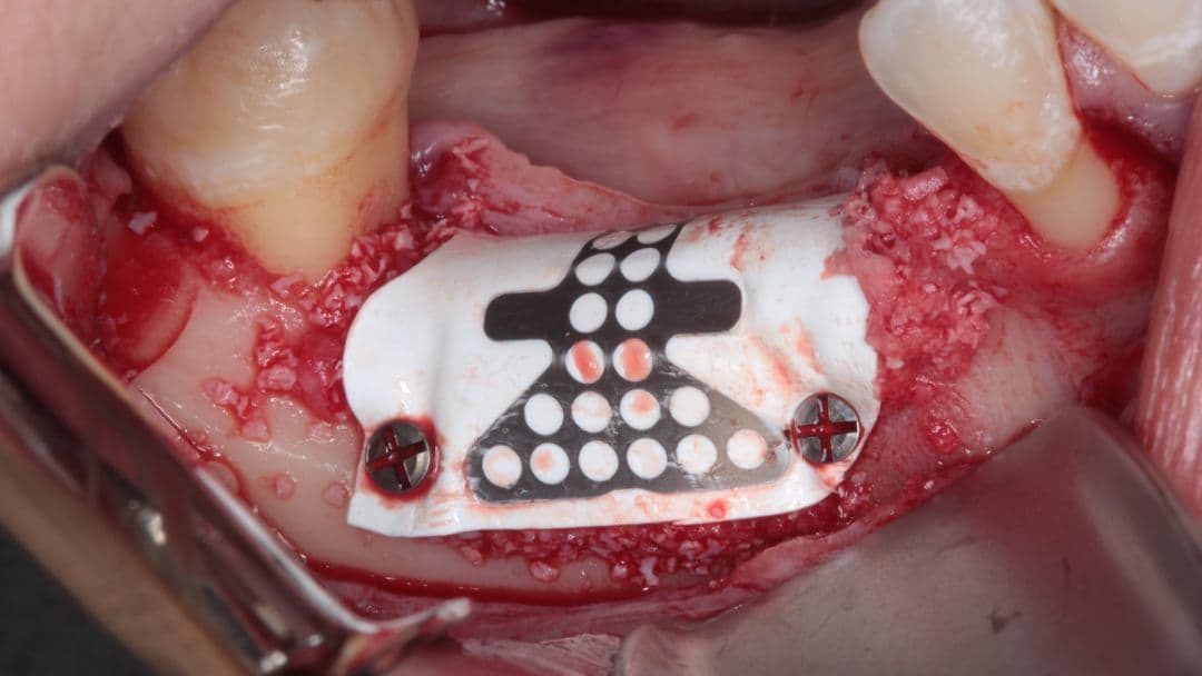 Membranlar: Türleri, Özellikleri ve Seçimini Etkileyen Faktörler