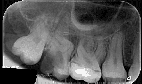 Aşırı Kurvatürlü Maksiller İkinci Molar (Diş 17) Tek Seans Kök Kanal Tedavisi ve Endokron Restorasyonu - Dt.Barkın Aksu
