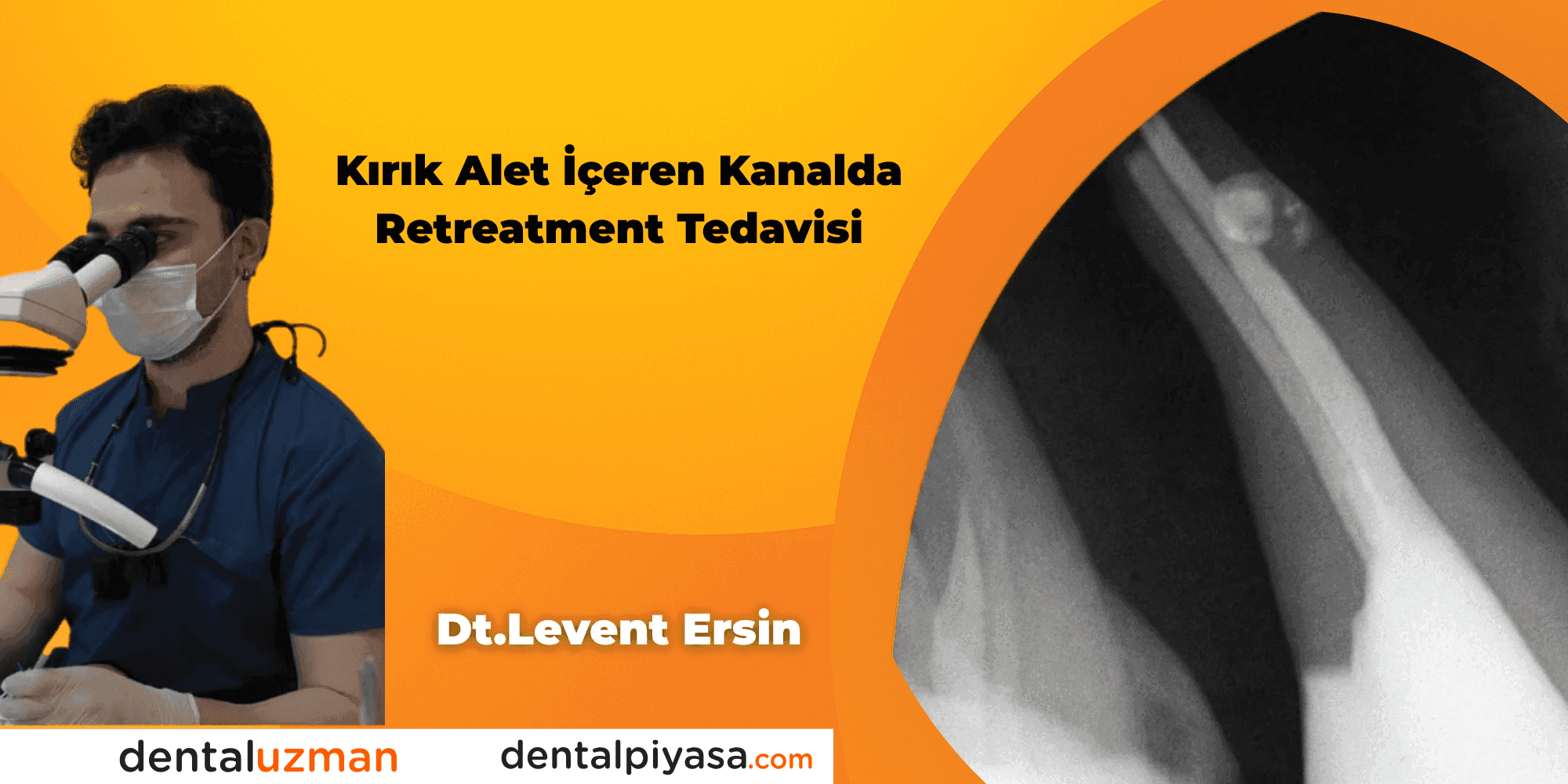 Kırık Alet İçeren Kanalda Retreatment Tedavisi    - Dt.Levent Ersin
