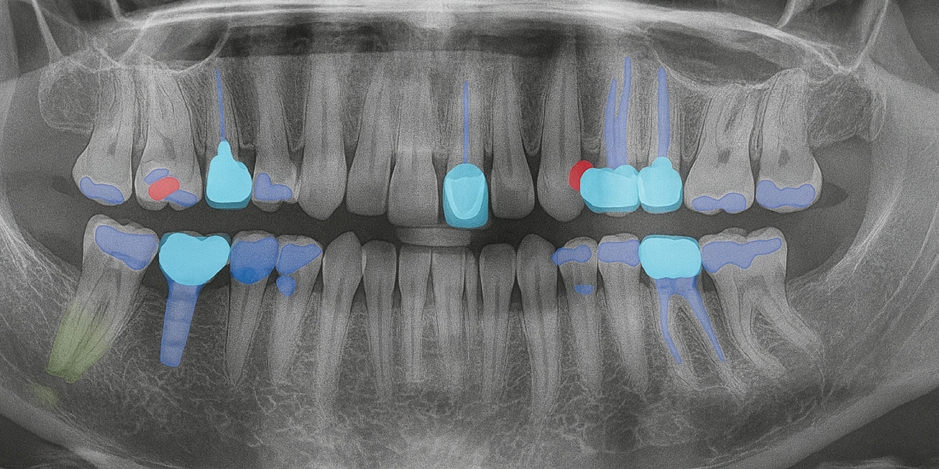 Yapay Zekâ Destekli Panoramik Röntgeni Analizi: Gerçekten Etkili mi?