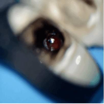 Kök Ucundan Taşmış Kırık Eğeye Sahip Alt Çene Büyükazı Dişinin Endodontik Yönetimi - Uzm. Dt. Yahya Güven - Görsel 10