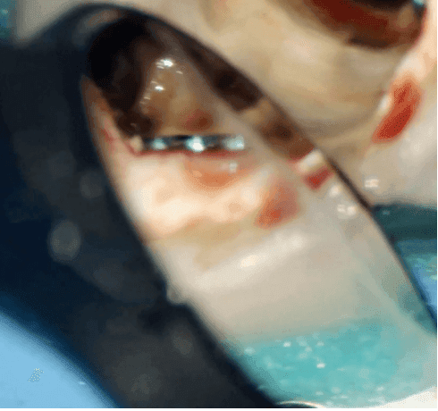 Kök Ucundan Taşmış Kırık Eğeye Sahip Alt Çene Büyükazı Dişinin Endodontik Yönetimi - Uzm. Dt. Yahya Güven - Görsel 11