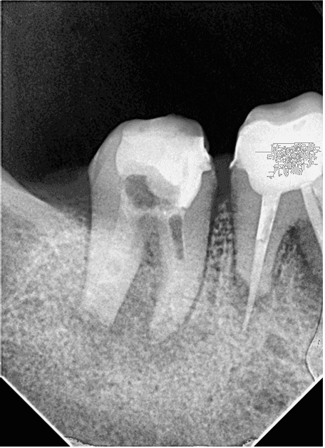 Kök Ucundan Taşmış Kırık Eğeye Sahip Alt Çene Büyükazı Dişinin Endodontik Yönetimi - Uzm. Dt. Yahya Güven - Görsel 12