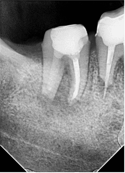 Kök Ucundan Taşmış Kırık Eğeye Sahip Alt Çene Büyükazı Dişinin Endodontik Yönetimi - Uzm. Dt. Yahya Güven - Görsel 13