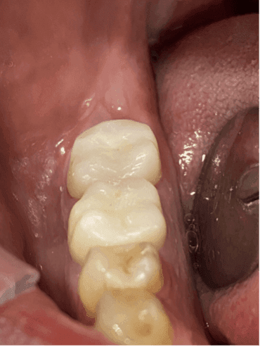 Kök Ucundan Taşmış Kırık Eğeye Sahip Alt Çene Büyükazı Dişinin Endodontik Yönetimi - Uzm. Dt. Yahya Güven - Görsel 14