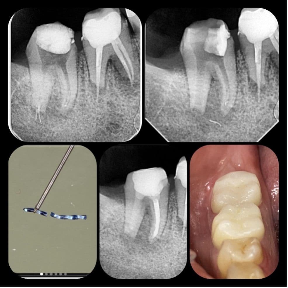 Kök Ucundan Taşmış Kırık Eğeye Sahip Alt Çene Büyükazı Dişinin Endodontik Yönetimi - Uzm. Dt. Yahya Güven - Görsel 15