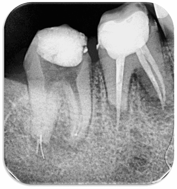 Kök Ucundan Taşmış Kırık Eğeye Sahip Alt Çene Büyükazı Dişinin Endodontik Yönetimi - Uzm. Dt. Yahya Güven - Görsel 1