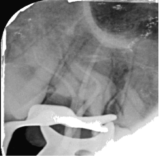 Aşırı Kurvatürlü Maksiller İkinci Molar (Diş 17) Tek Seans Kök Kanal Tedavisi ve Endokron Restorasyonu - Dt.Barkın Aksu - Görsel 2