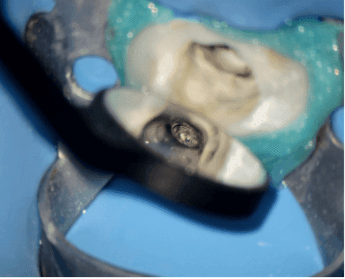 Kök Ucundan Taşmış Kırık Eğeye Sahip Alt Çene Büyükazı Dişinin Endodontik Yönetimi - Uzm. Dt. Yahya Güven - Görsel 2