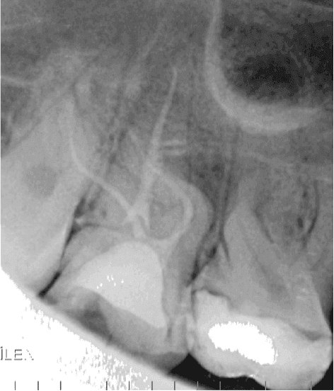 Aşırı Kurvatürlü Maksiller İkinci Molar (Diş 17) Tek Seans Kök Kanal Tedavisi ve Endokron Restorasyonu - Dt.Barkın Aksu - Görsel 3