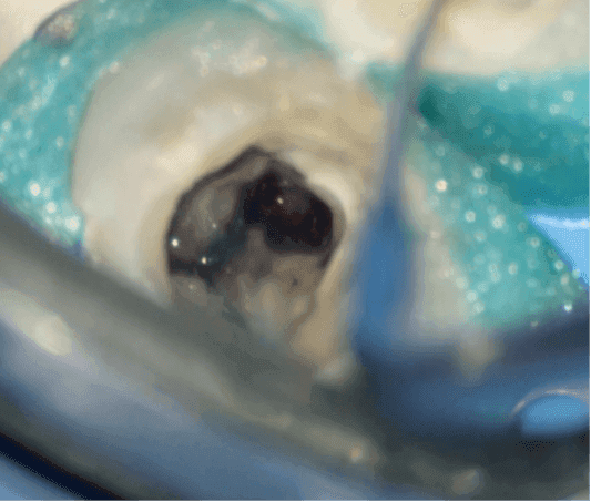 Kök Ucundan Taşmış Kırık Eğeye Sahip Alt Çene Büyükazı Dişinin Endodontik Yönetimi - Uzm. Dt. Yahya Güven - Görsel 3