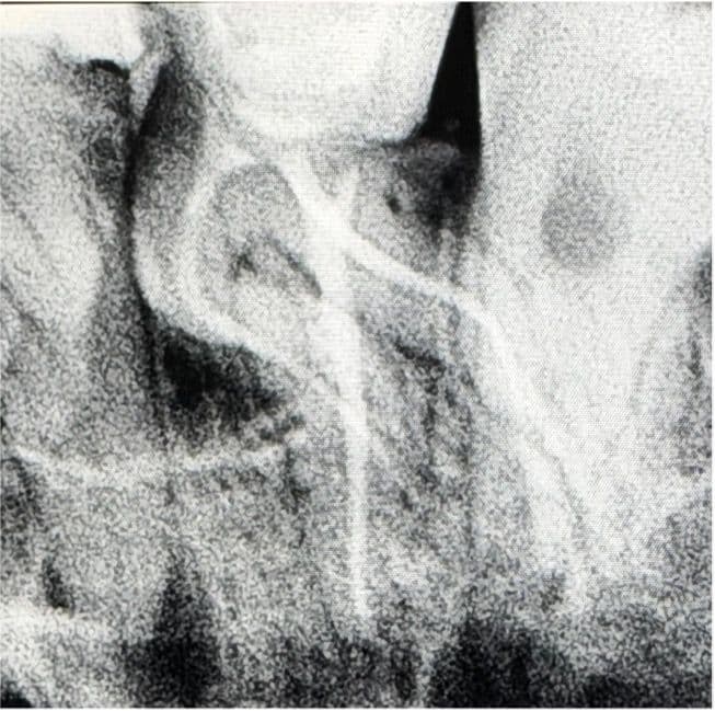 Aşırı Kurvatürlü Maksiller İkinci Molar (Diş 17) Tek Seans Kök Kanal Tedavisi ve Endokron Restorasyonu - Dt.Barkın Aksu - Görsel 4