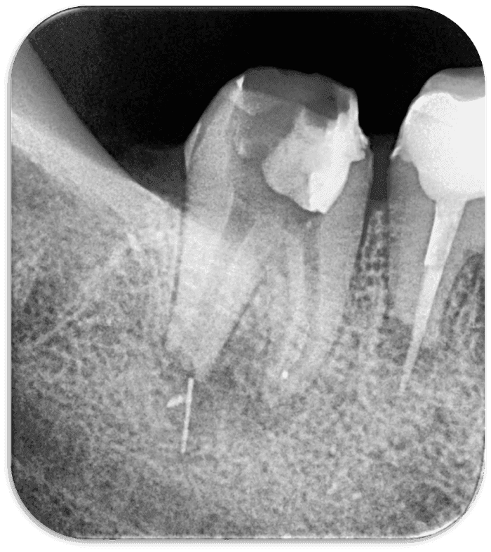 Kök Ucundan Taşmış Kırık Eğeye Sahip Alt Çene Büyükazı Dişinin Endodontik Yönetimi - Uzm. Dt. Yahya Güven - Görsel 4