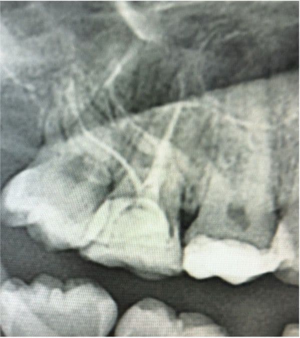 Aşırı Kurvatürlü Maksiller İkinci Molar (Diş 17) Tek Seans Kök Kanal Tedavisi ve Endokron Restorasyonu - Dt.Barkın Aksu - Görsel 5