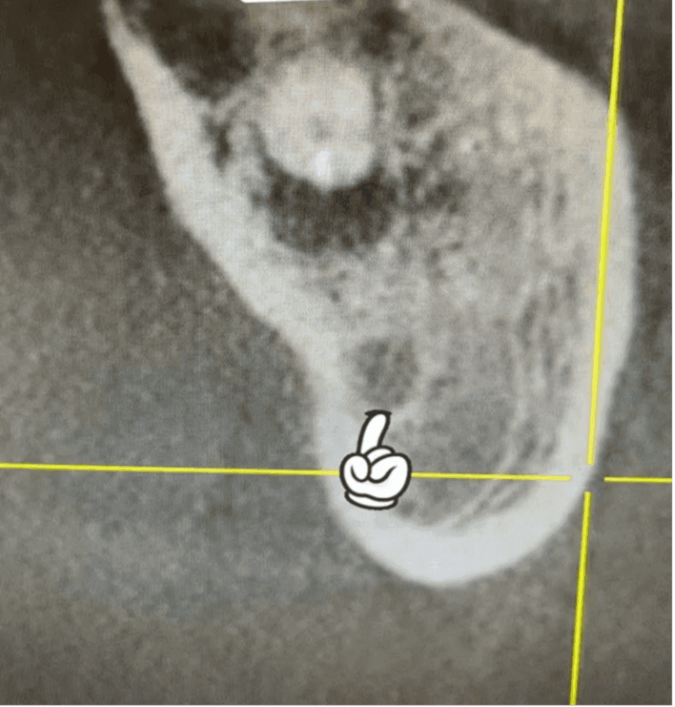 Kök Ucundan Taşmış Kırık Eğeye Sahip Alt Çene Büyükazı Dişinin Endodontik Yönetimi - Uzm. Dt. Yahya Güven - Görsel 5