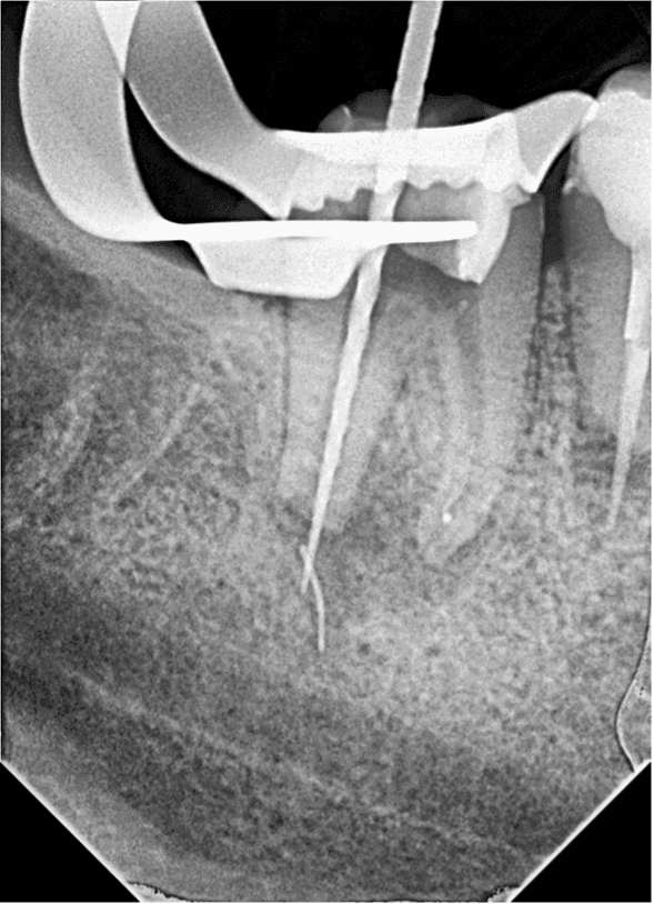 Kök Ucundan Taşmış Kırık Eğeye Sahip Alt Çene Büyükazı Dişinin Endodontik Yönetimi - Uzm. Dt. Yahya Güven - Görsel 6