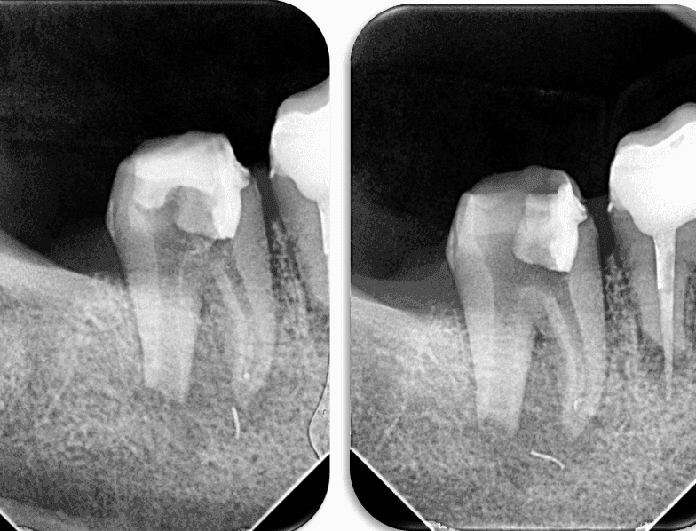 Kök Ucundan Taşmış Kırık Eğeye Sahip Alt Çene Büyükazı Dişinin Endodontik Yönetimi - Uzm. Dt. Yahya Güven - Görsel 9