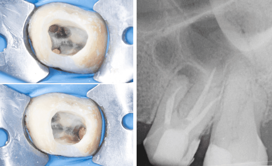 Apikal Üçlüde Kırık Alet ve Basamak Bulunan Dişin Retreatment Tedavisi - Dt.Abdullah Özceylan