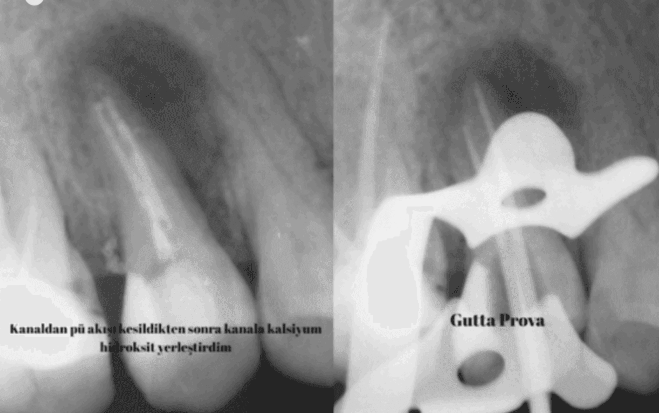 Kırık Alet İçeren Kanalda Retreatment Tedavisi - Dt.Levent Ersin