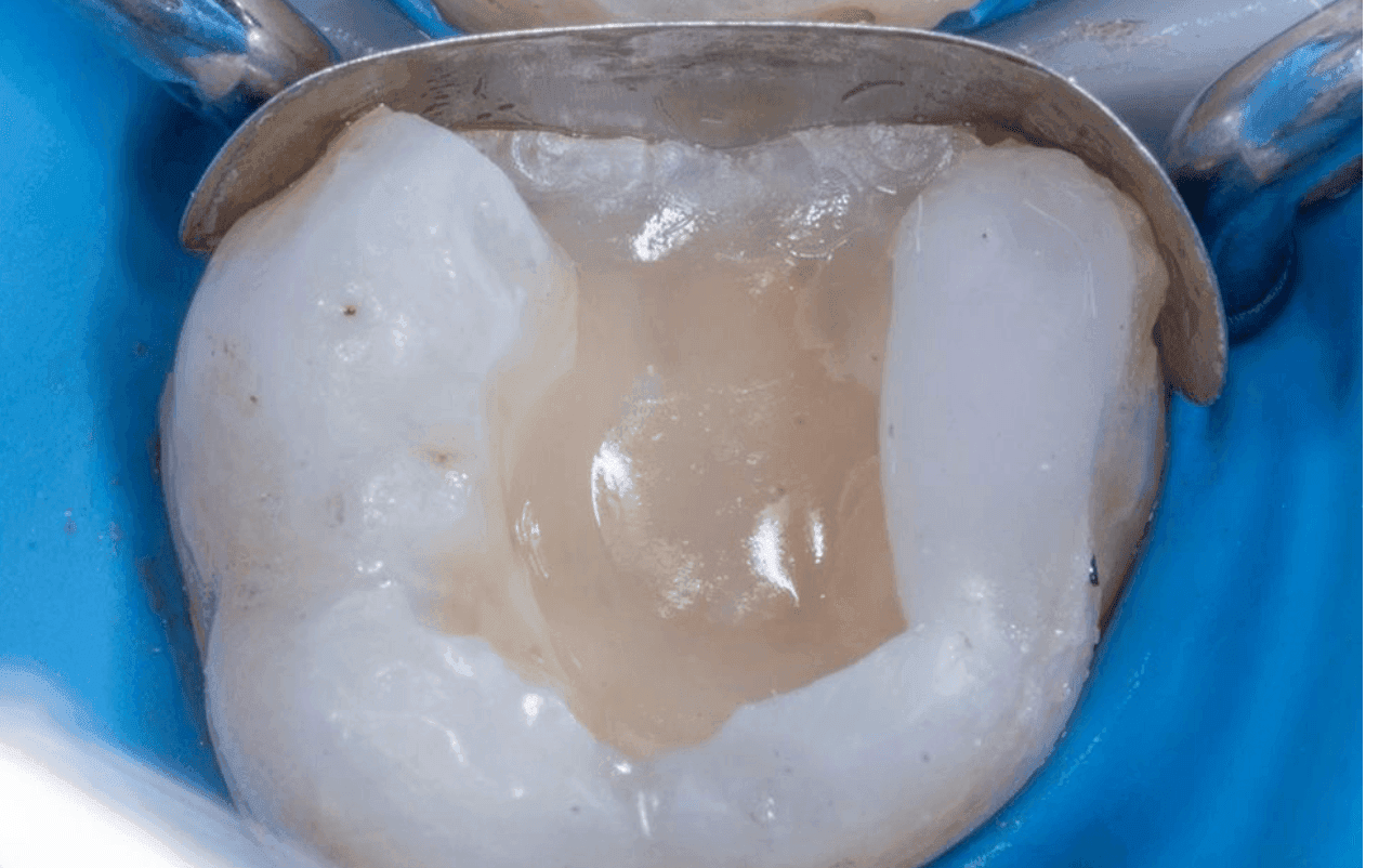 Biyomimetik Prensiplere Dayalı Amalgam Restorasyonun Yenilenmesi - Dt.Abdullah Özceylan