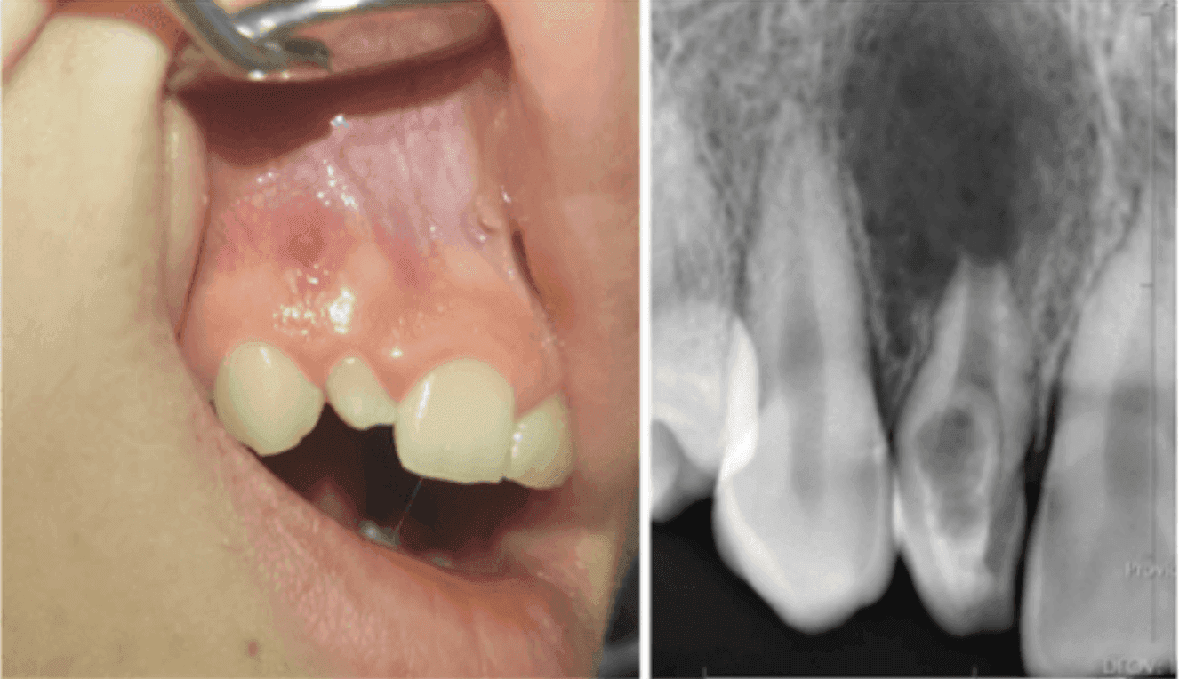 Dens İnvaginatus Kaynaklı Nekrotik İmmatür Dişte MTA Apeksifikasyonu - Uzm. Dt. Eda Doğuş