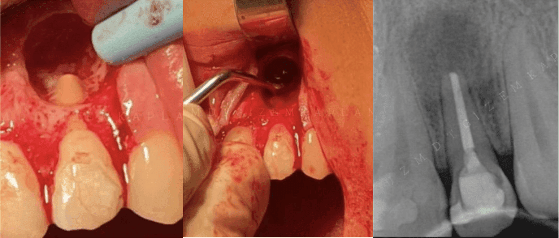 Geniş Periapikal Lezyonlu Bir Dişin Retreatment’a Ek Olarak Periapikal Cerrahi Tedavisi - Uzm. Dt. Gizem Kaplan