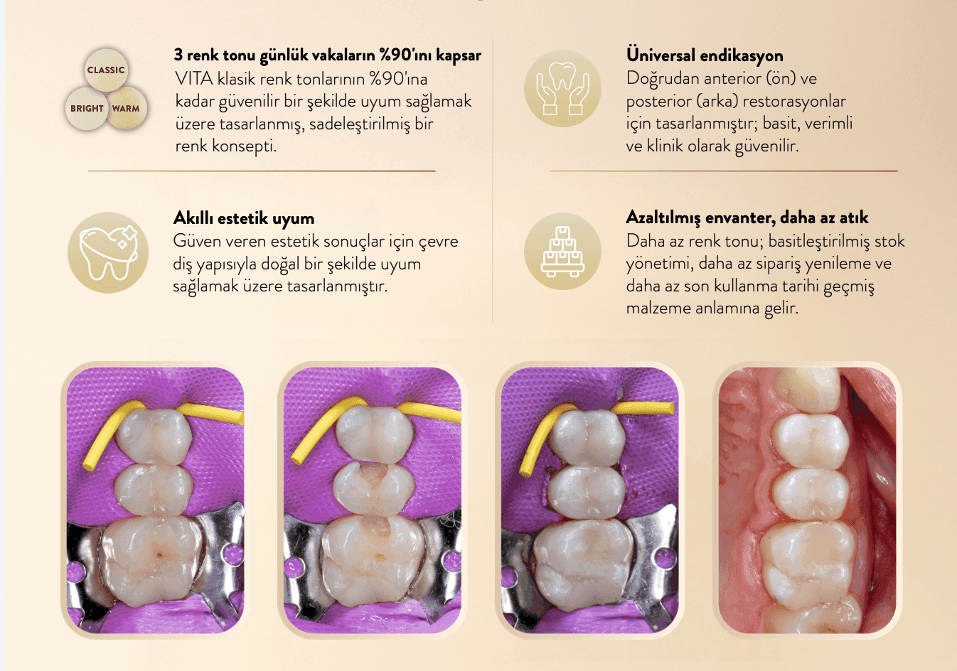Kompozitlerde Klinik Performans Analizi: Saremco MHC Mikro Hibrit Kompozit - Görsel 2