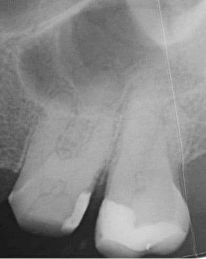 Apikal Üçlüde Kırık Alet ve Basamak Bulunan Dişin Retreatment Tedavisi - Dt.Abdullah Özceylan - Görsel 1