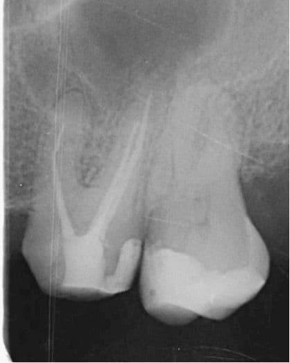 Apikal Üçlüde Kırık Alet ve Basamak Bulunan Dişin Retreatment Tedavisi - Dt.Abdullah Özceylan - Görsel 2