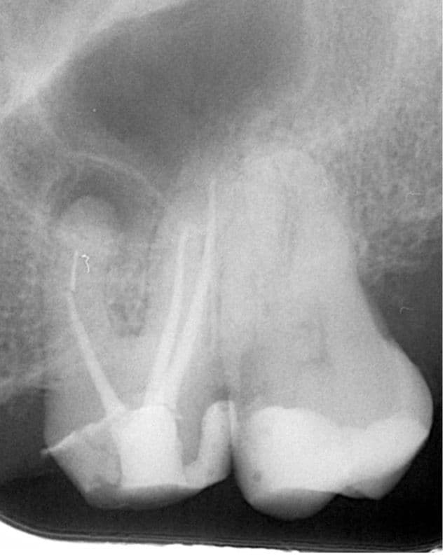 Apikal Üçlüde Kırık Alet ve Basamak Bulunan Dişin Retreatment Tedavisi - Dt.Abdullah Özceylan - Görsel 3
