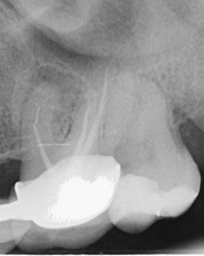 Apikal Üçlüde Kırık Alet ve Basamak Bulunan Dişin Retreatment Tedavisi - Dt.Abdullah Özceylan - Görsel 4