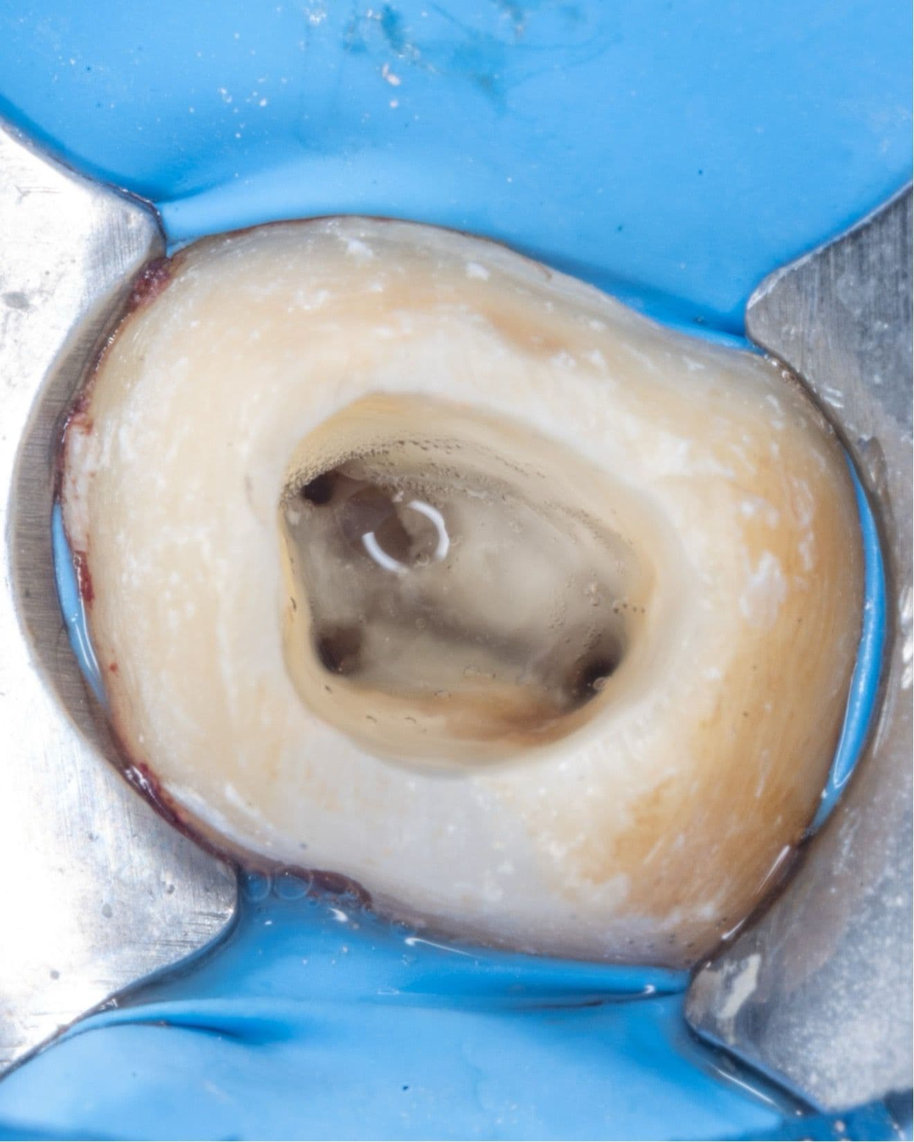 Apikal Üçlüde Kırık Alet ve Basamak Bulunan Dişin Retreatment Tedavisi - Dt.Abdullah Özceylan - Görsel 5