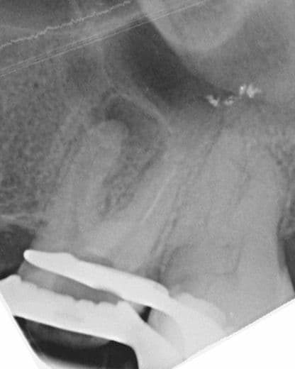 Apikal Üçlüde Kırık Alet ve Basamak Bulunan Dişin Retreatment Tedavisi - Dt.Abdullah Özceylan - Görsel 6