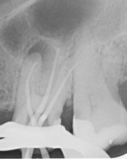 Apikal Üçlüde Kırık Alet ve Basamak Bulunan Dişin Retreatment Tedavisi - Dt.Abdullah Özceylan - Görsel 7
