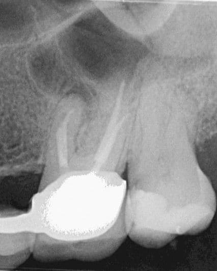 Apikal Üçlüde Kırık Alet ve Basamak Bulunan Dişin Retreatment Tedavisi - Dt.Abdullah Özceylan - Görsel 9