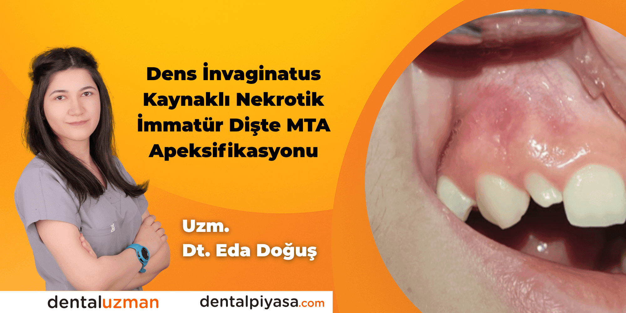 Dens İnvaginatus Kaynaklı Nekrotik İmmatür Dişte MTA Apeksifikasyonu - Uzm. Dt. Eda Doğuş
