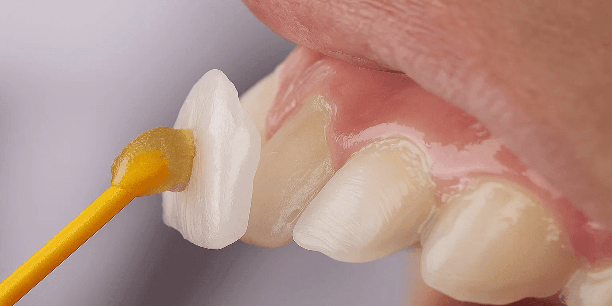 Beautifully Imperfect: Hollywood Smile Rafa Mı Kalkıyor Yoksa Değişiyor Mu?